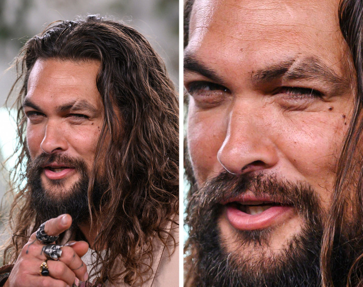 Celebrities with Cleft Lips and Palates