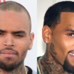 celebrity hair transplants: What We Know, What We Don’t