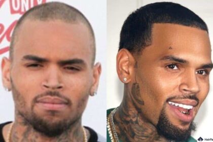 celebrity hair transplants: What We Know, What We Don’t
