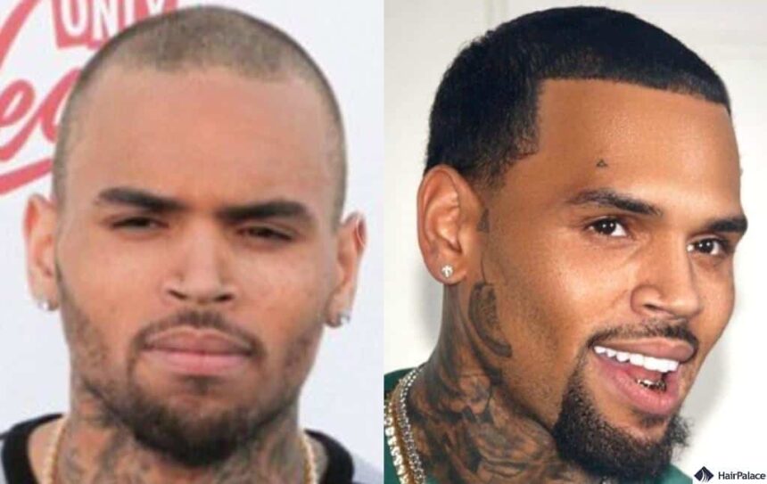 celebrity hair transplants: What We Know, What We Don’t