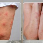 Bed Bug vs Spider Bites: How to Tell the Difference and What to Do