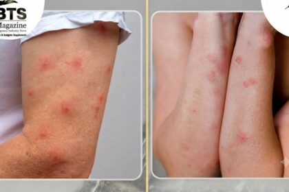 Bed Bug vs Spider Bites: How to Tell the Difference and What to Do