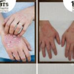 Dermatitis Explained: What It Is, Why It Happens, and How to Deal With It