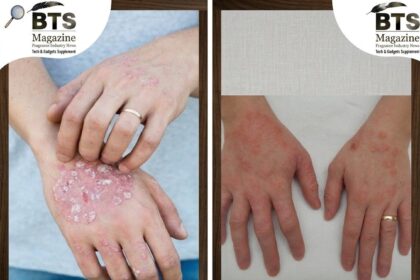 Dermatitis Explained: What It Is, Why It Happens, and How to Deal With It