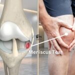 Meniscus: Everything You Need to Know About This Tiny but Mighty Knee Cartilage