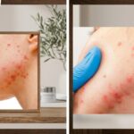 Pimples Dermatologist: Everything You Need to Know About Treating Acne the Right Way