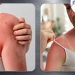 Sun Poisoning: What It Really Is and Why You Shouldn't Ignore It