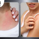 West Nile Virus Symptoms: What You Need to Know Before Mosquito Season Hits