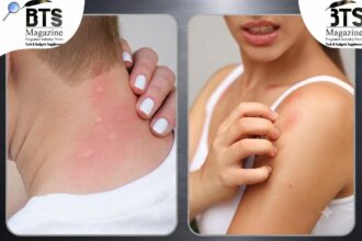 West Nile Virus Symptoms: What You Need to Know Before Mosquito Season Hits